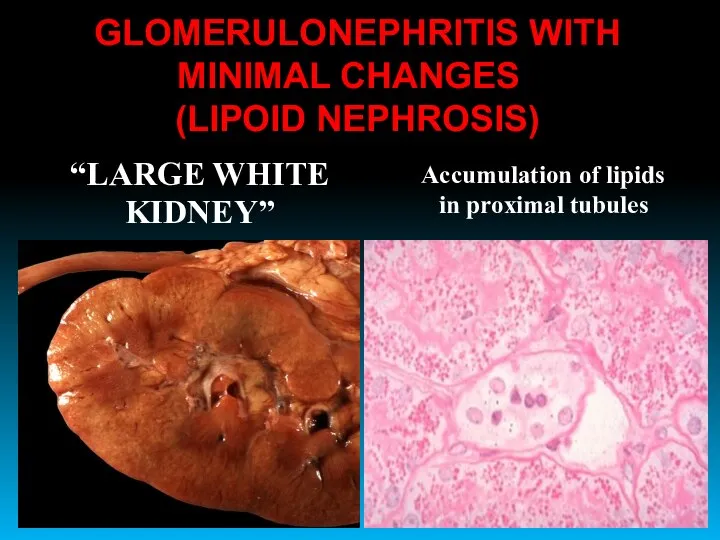“LARGE WHITE KIDNEY” Accumulation of lipids in proximal tubules GLOMERULONEPHRITIS WITH MINIMAL CHANGES (LIPOID NEPHROSIS)