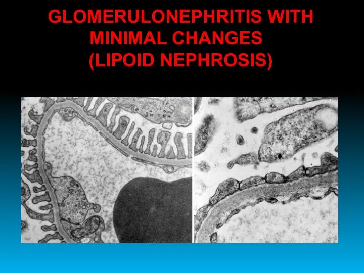 GLOMERULONEPHRITIS WITH MINIMAL CHANGES (LIPOID NEPHROSIS)