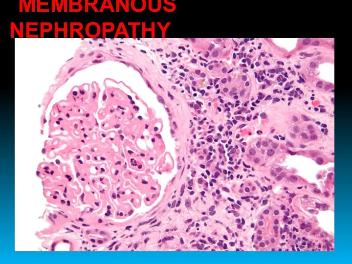 MEMBRANOUS NEPHROPATHY