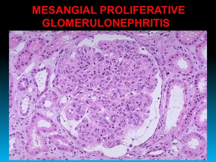 MESANGIAL PROLIFERATIVE GLOMERULONEPHRITIS