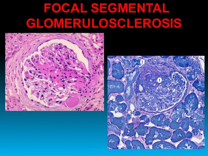 FOCAL SEGMENTAL GLOMERULOSCLEROSIS