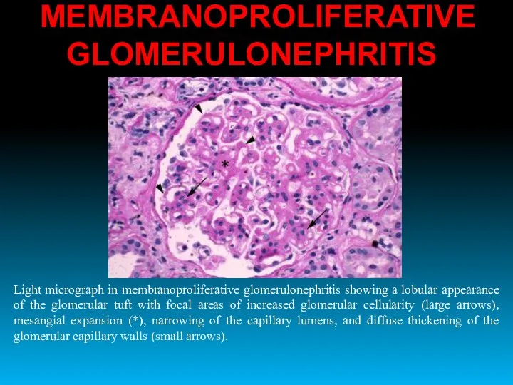 MEMBRANOPROLIFERATIVE GLOMERULONEPHRITIS Light micrograph in membranoproliferative glomerulonephritis showing a lobular appearance