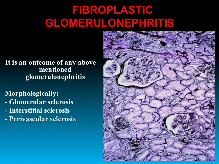 FIBROPLASTIC GLOMERULONEPHRITIS It is an outcome of any above mentioned glomerulonephritis
