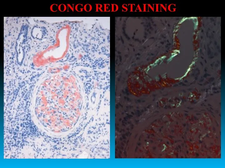 CONGO RED STAINING