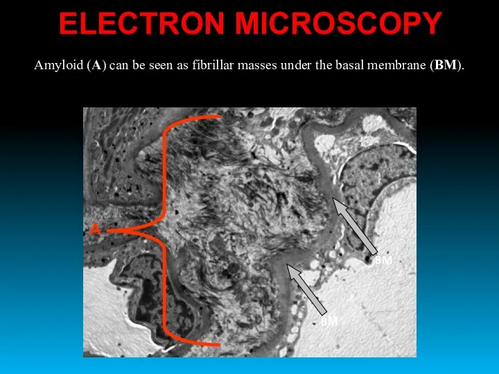Amyloid (А) can be seen as fibrillar masses under the basal membrane (BM). ELECTRON MICROSCOPY