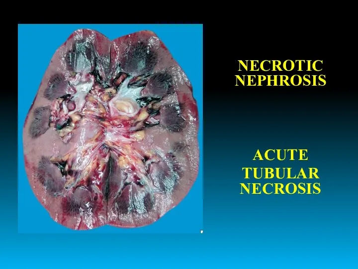 NECROTIC NEPHROSIS ACUTE TUBULAR NECROSIS