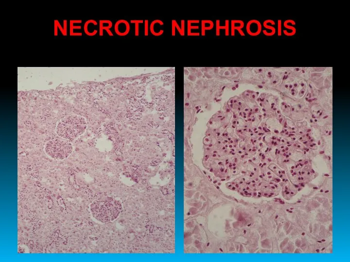 NECROTIC NEPHROSIS