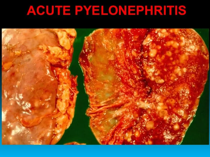 ACUTE PYELONEPHRITIS