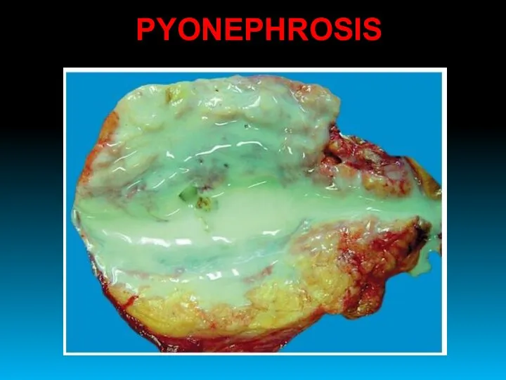 PYONEPHROSIS