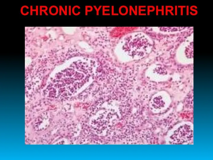 CHRONIC PYELONEPHRITIS