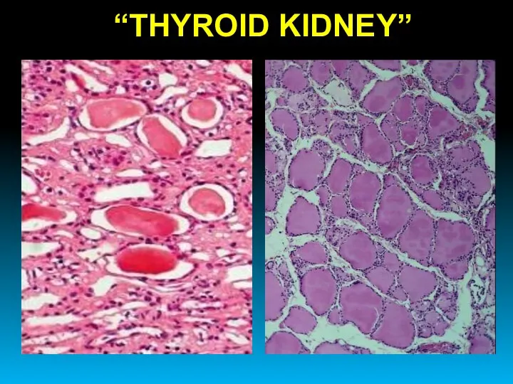 “THYROID KIDNEY”