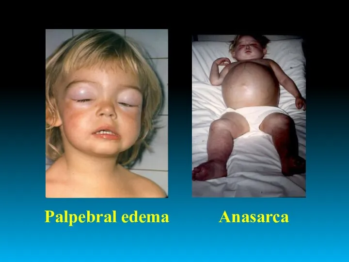 Palpebral edema Anasarca