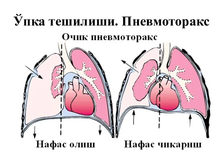 Ўпка тешилиши. Пневмоторакс