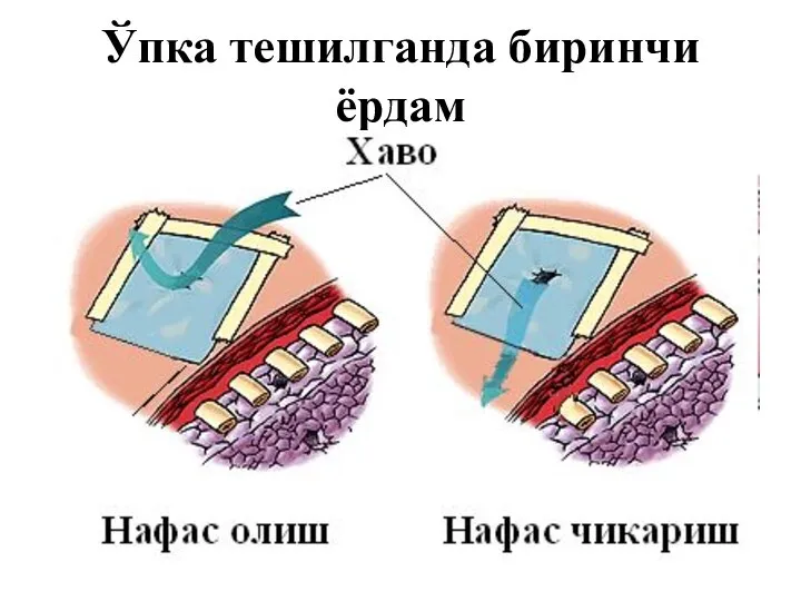 Ўпка тешилганда биринчи ёрдам