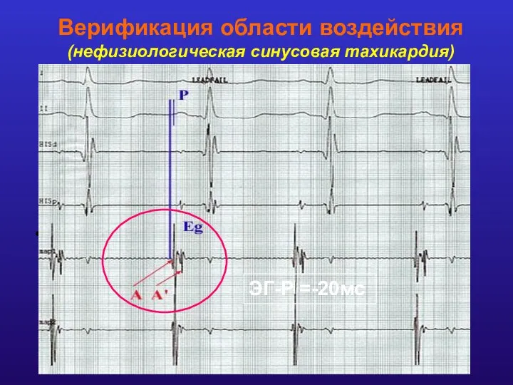 Верификация области воздействия (нефизиологическая синусовая тахикардия) Область наиболее ранней активации Зона