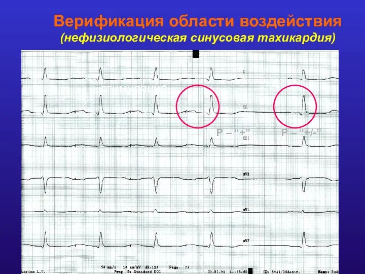 Верификация области воздействия (нефизиологическая синусовая тахикардия) Выявление области наиболее ранней активации