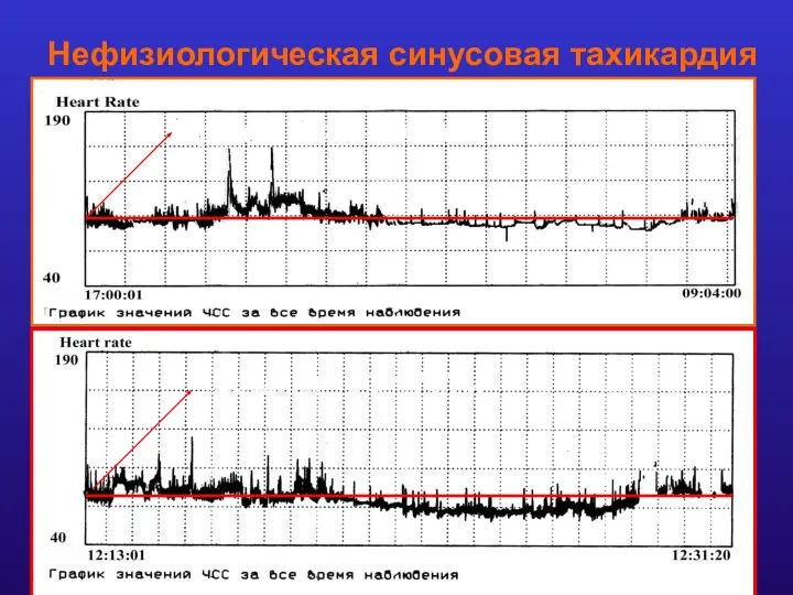 Нефизиологическая синусовая тахикардия (суточная ритмограмма) До операции: После операции: Средняя ЧСС