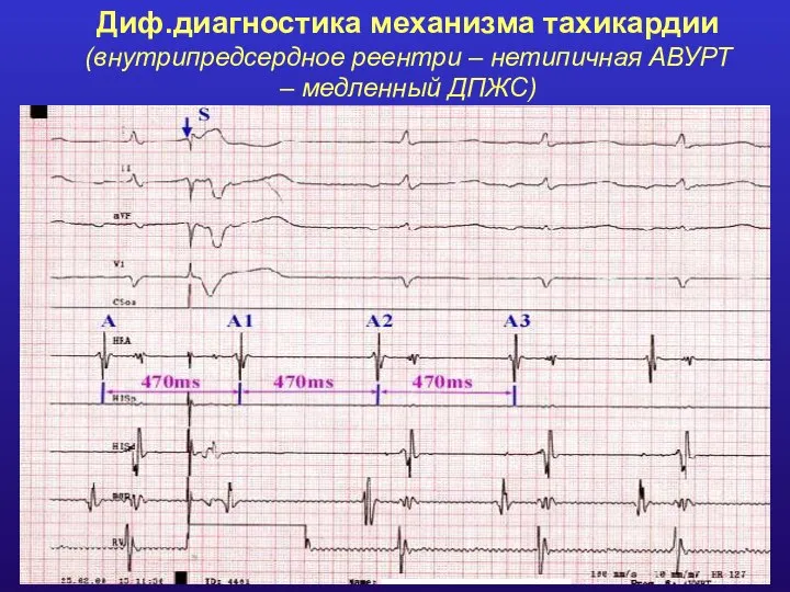 Диф.диагностика механизма тахикардии (внутрипредсердное реентри – нетипичная АВУРТ – медленный ДПЖС)