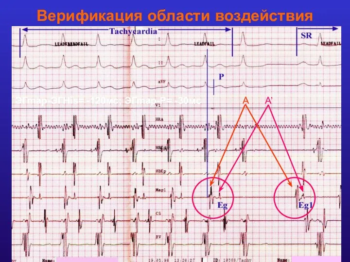 Верификация области воздействия (внутрипредсердное ри-ентри) Картирование «пограничного гребня» Выявление зоны наиболее