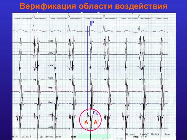 Верификация области воздействия (внутрипредсердное ри-ентри) Картирование «пограничного гребня» Выявление зоны наиболее