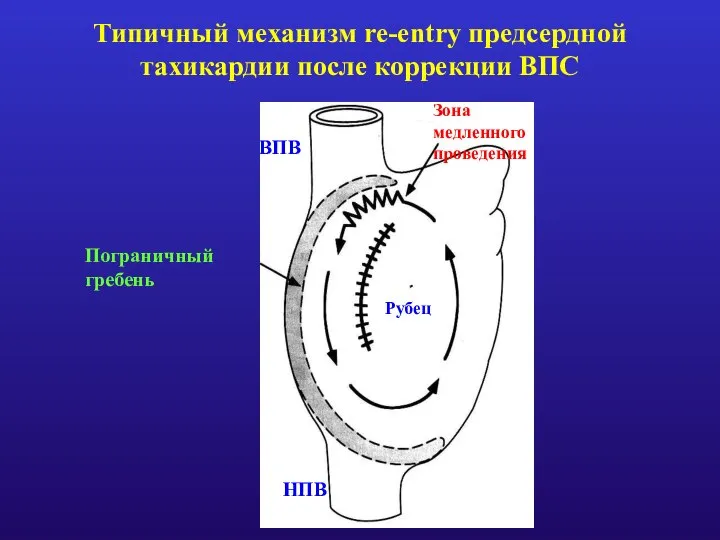 ВПВ НПВ Зона медленного проведения Рубец Типичный механизм re-entry предсердной тахикардии после коррекции ВПС