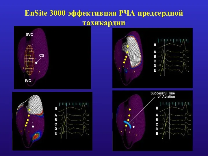 EnSite 3000 эффективная РЧА предсердной тахикардии