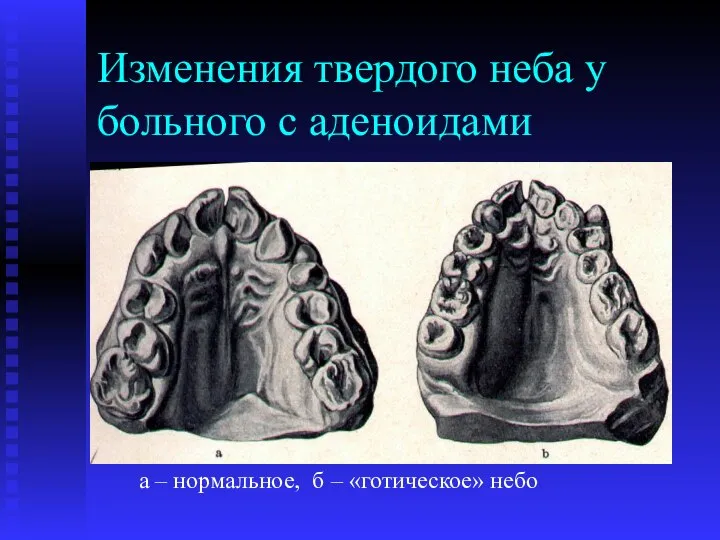 Изменения твердого неба у больного с аденоидами а – нормальное, б – «готическое» небо