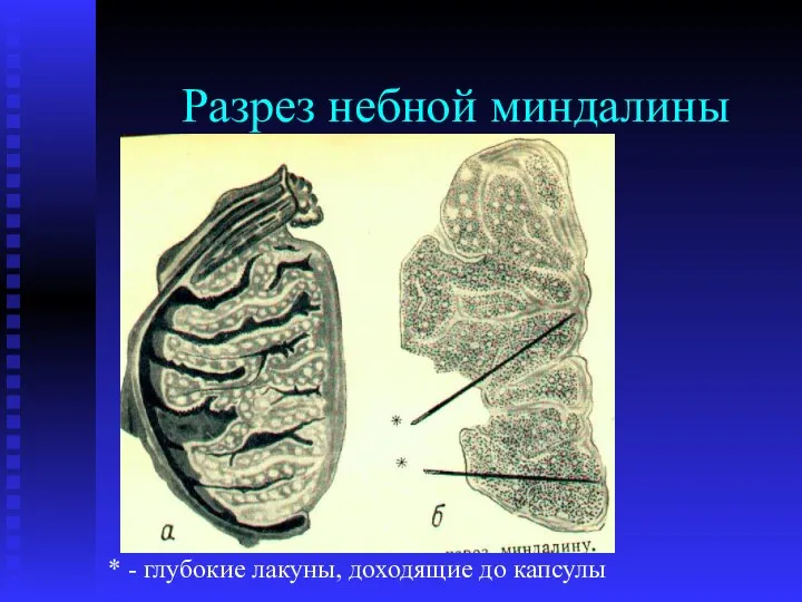 Разрез небной миндалины * - глубокие лакуны, доходящие до капсулы