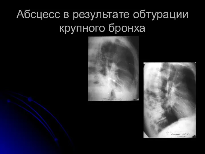 Абсцесс в результате обтурации крупного бронха