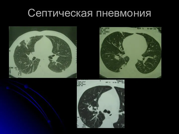 Септическая пневмония