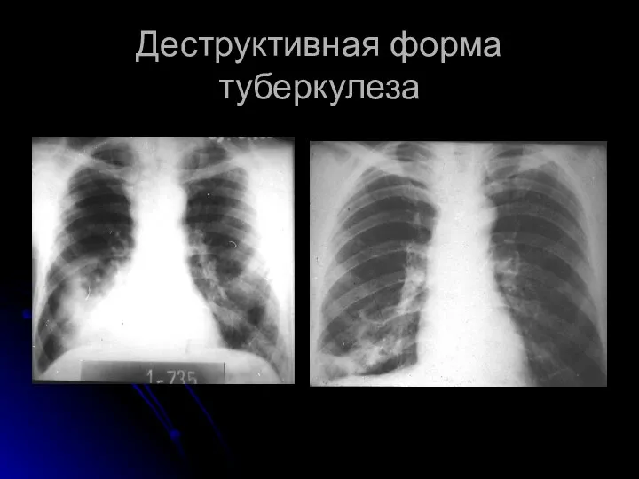 Деструктивная форма туберкулеза