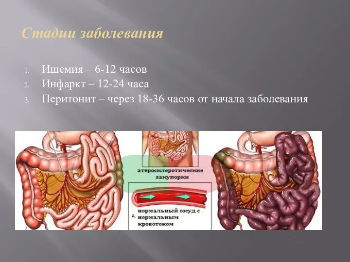 Стадии заболевания Ишемия – 6-12 часов Инфаркт – 12-24 часа Перитонит