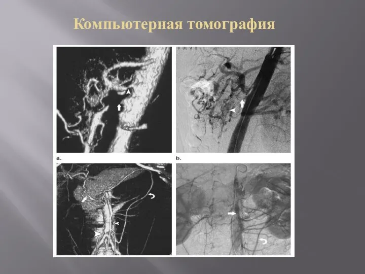 Компьютерная томография