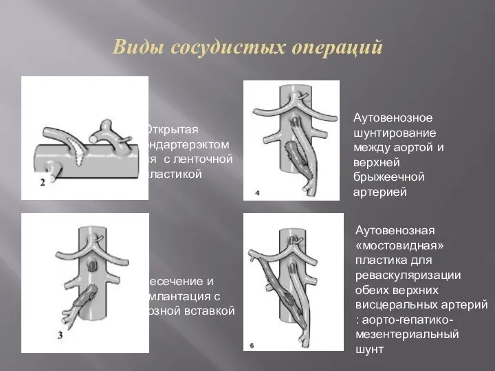 Виды сосудистых операций Открытая эндартерэктомия с ленточной пластикой Пересечение и реимлантация