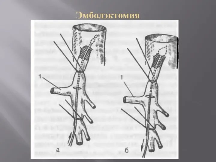 Эмболэктомия