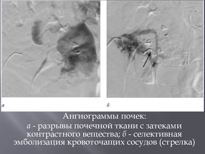 Ангиограммы почек: а - разрывы почечной ткани с затеками контрастного вещества;