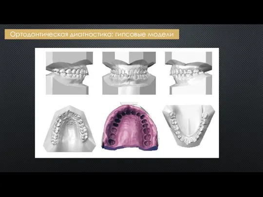Ортодонтическая диагностика: гипсовые модели