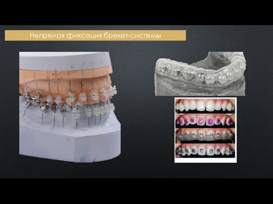 Непрямая фиксация брекет-системы