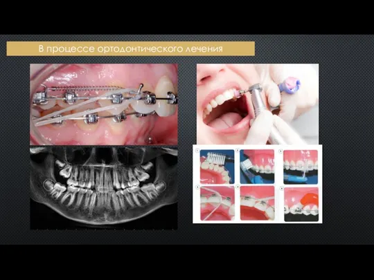 В процессе ортодонтического лечения