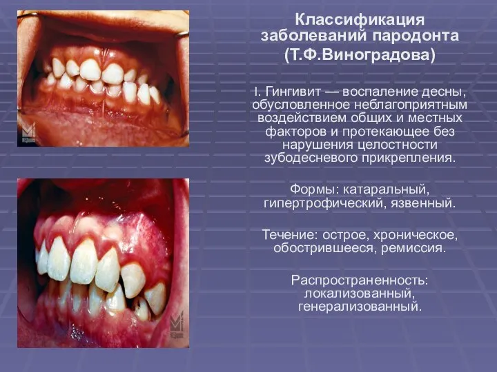 Классификация заболеваний пародонта (Т.Ф.Виноградова) I. Гингивит — воспаление десны, обусловленное неблагоприятным