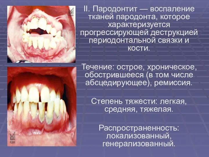 II. Пародонтит — воспаление тканей пародонта, которое характеризуется прогрессирующей деструкцией периодонтальной