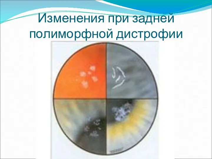 Изменения при задней полиморфной дистрофии