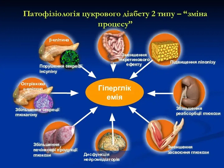 Патофізіологія цукрового діабету 2 типу – “зміна процесу” Зменшення засвоєння глюкози