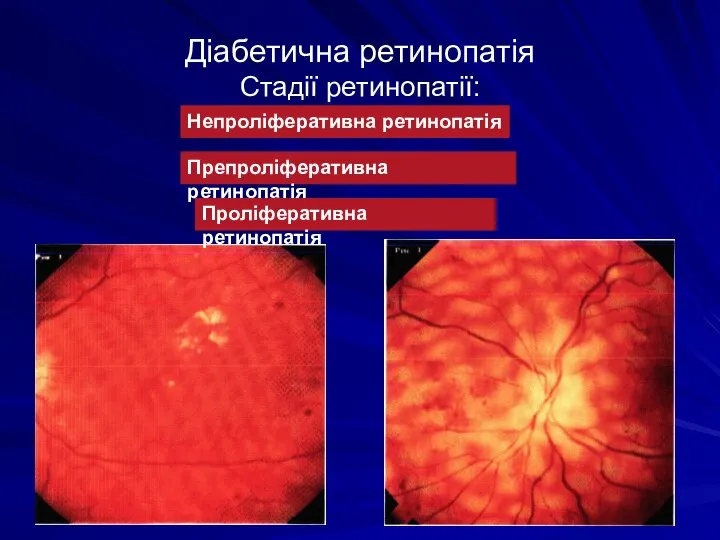 Діабетична ретинопатія Стадії ретинопатії: Непроліферативна ретинопатія Препроліферативна ретинопатія Проліферативна ретинопатія