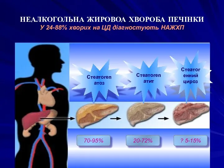 НЕАЛКОГОЛЬНА ЖИРОВОА ХВОРОБА ПЕЧІНКИ У 24-88% хворих на ЦД діагностують НАЖХП