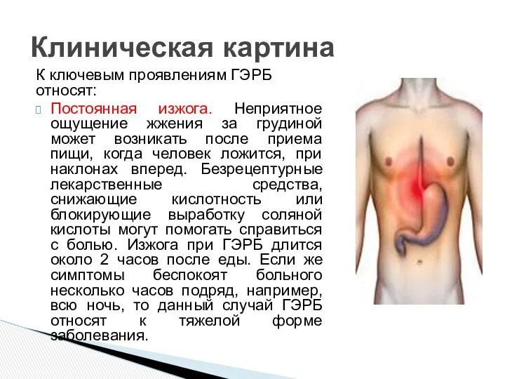 К ключевым проявлениям ГЭРБ относят: Постоянная изжога. Неприятное ощущение жжения за