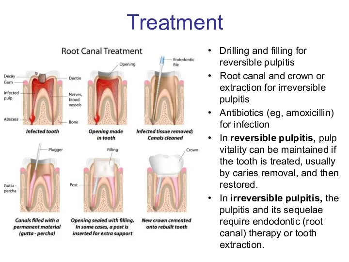 Treatment Drilling and filling for reversible pulpitis Root canal and crown