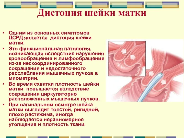 Дистоция шейки матки Одним из основных симптомов ДСРД является дистоция шейки