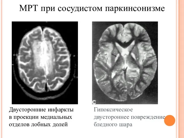 МРТ при сосудистом паркинсонизме Гипоксическое двустороннее повреждение бледного шара Двусторонние инфаркты