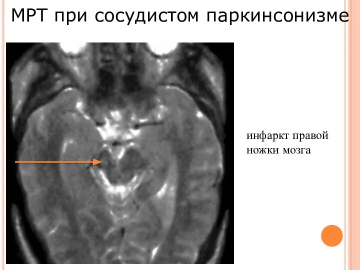 МРТ при сосудистом паркинсонизме инфаркт правой ножки мозга